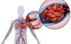 Coronavirus causes Thrombosis