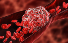 Coronavirus causes Thrombosis