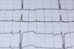 Cardiogram readings. ECG meanings