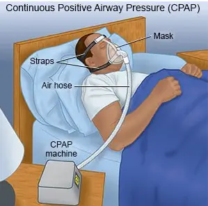APAP vs CPAP Machines. What's the difference?
